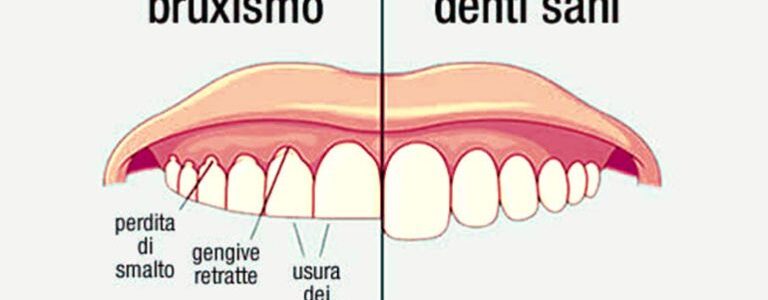BOTOX for BRUXISM